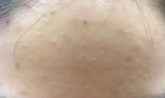 去除粉刺的注意事項有哪些？