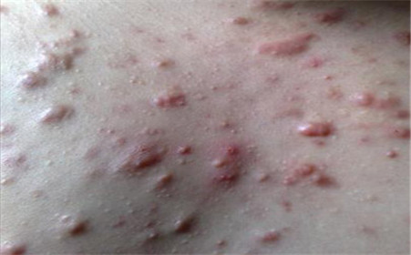 什么是痤瘡，什么是粉刺？痤瘡和粉刺有啥區別？